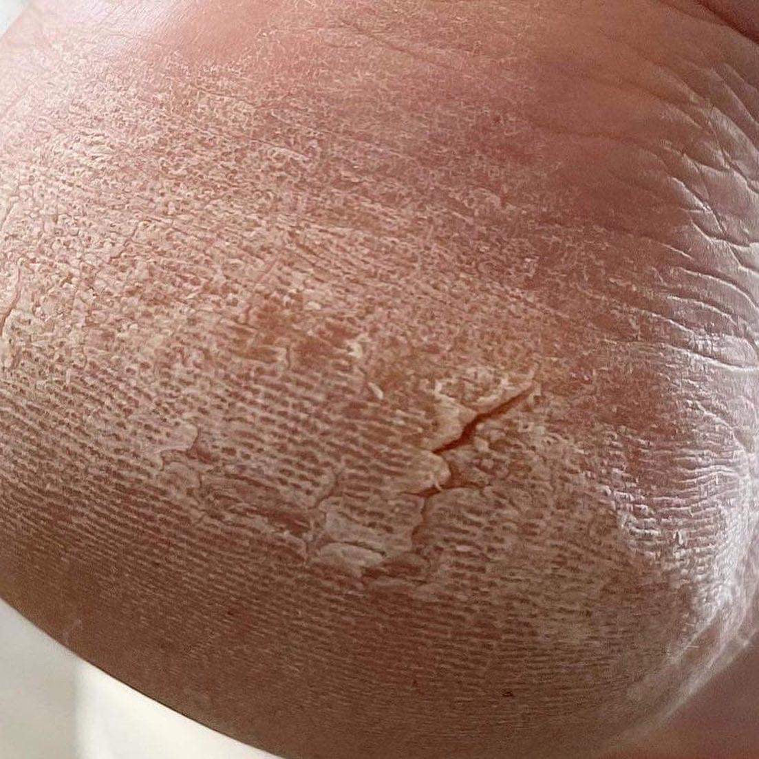 Advance pedicure