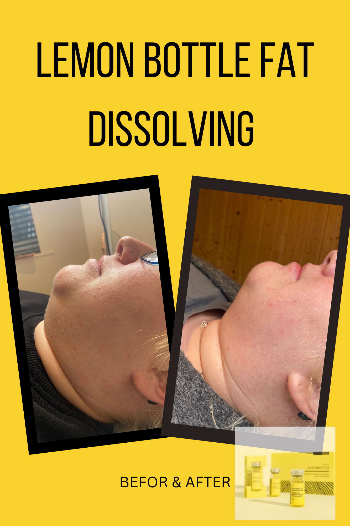Lemon Bottle Fat Dissolving Training Course
